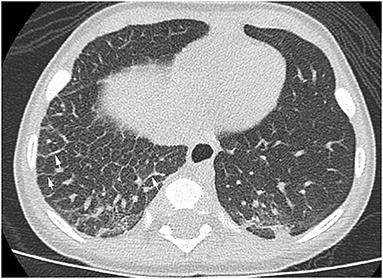 Case Report: A Relatively Mild Presentation of Unilateral Congenital Pulmonary Lymphangiectasia